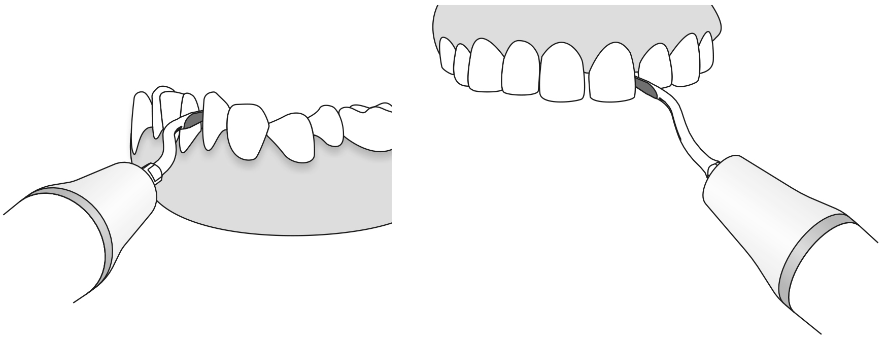 Сфера применения наконечника для скалера